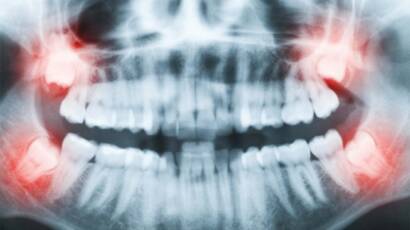 Yirmilik Diş Çekilmezse Ne Olur? Yirmilik Diş Neden Çekilir?